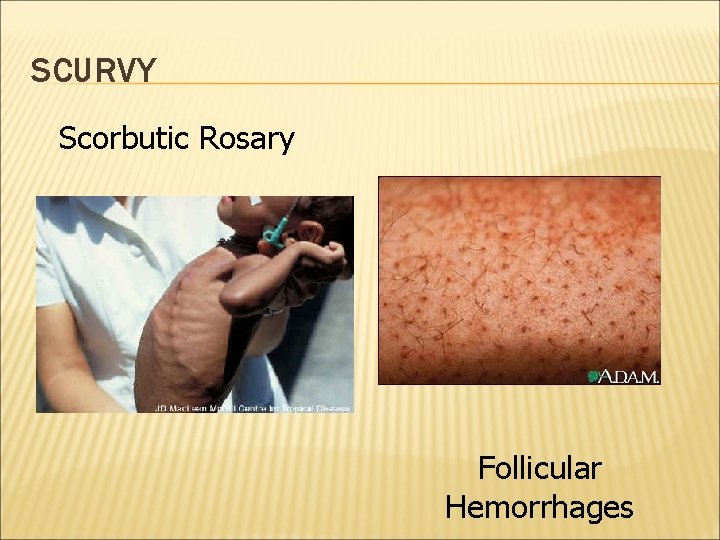 SCURVY Scorbutic Rosary Follicular Hemorrhages 