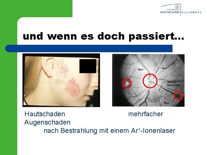 und wenn es doch passiert. . . Hautschaden mehrfacher Augenschaden nach Bestrahlung mit einem