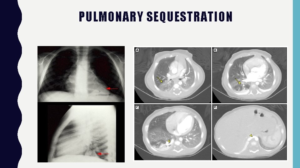PULMONARY SEQUESTRATION 