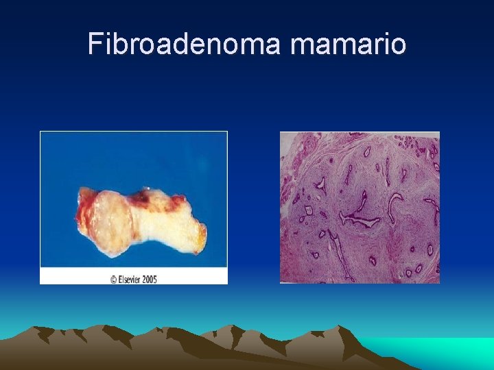 Fibroadenoma mamario 