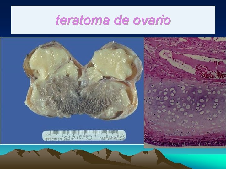 teratoma de ovario 