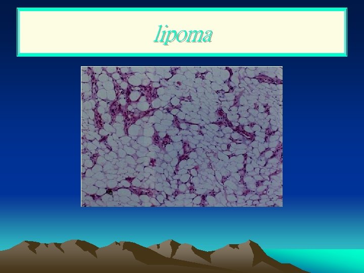 lipoma 