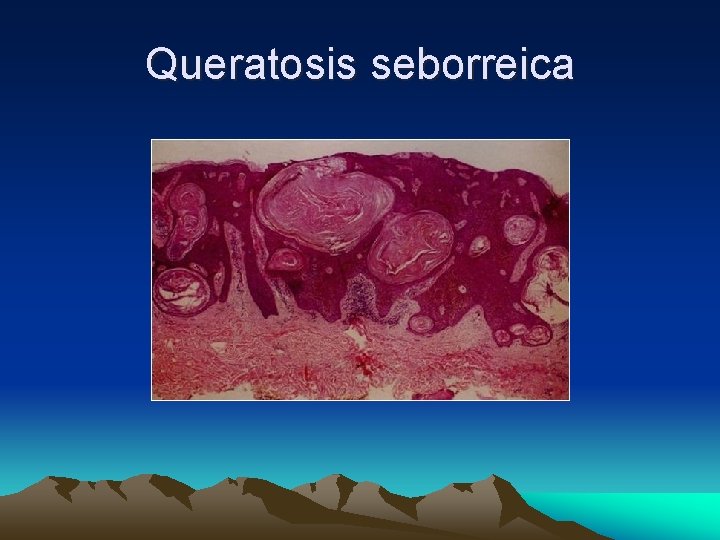 Queratosis seborreica 