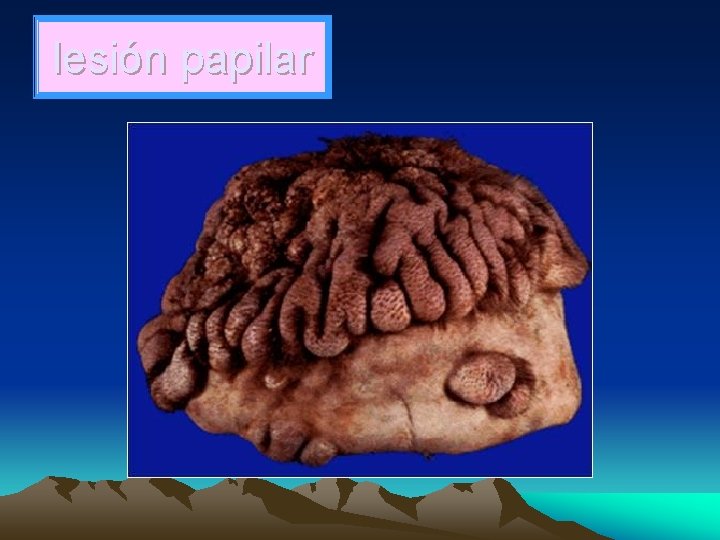 lesión papilar 