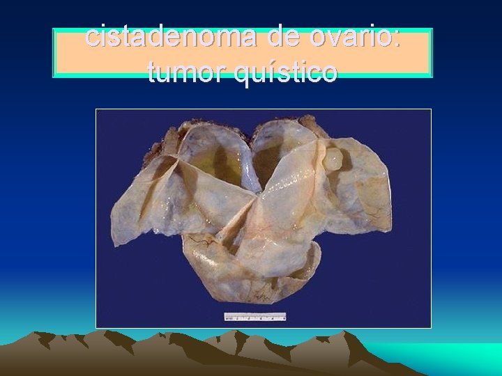 cistadenoma de ovario: tumor quístico 