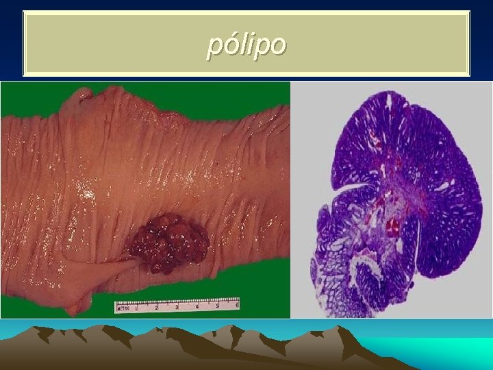 pólipo 