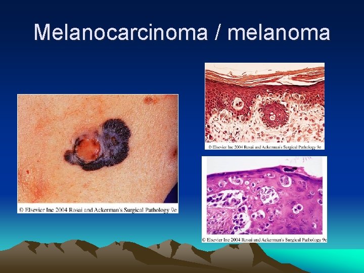 Melanocarcinoma / melanoma 