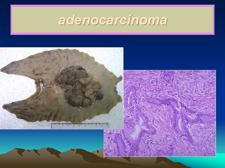 adenocarcinoma 