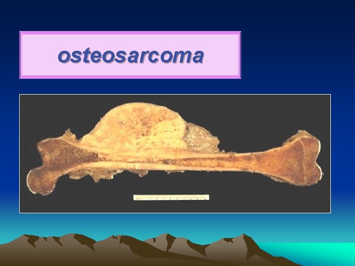 osteosarcoma 
