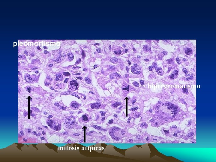 pleomorfismo hipercromatismo mitosis atípicas 