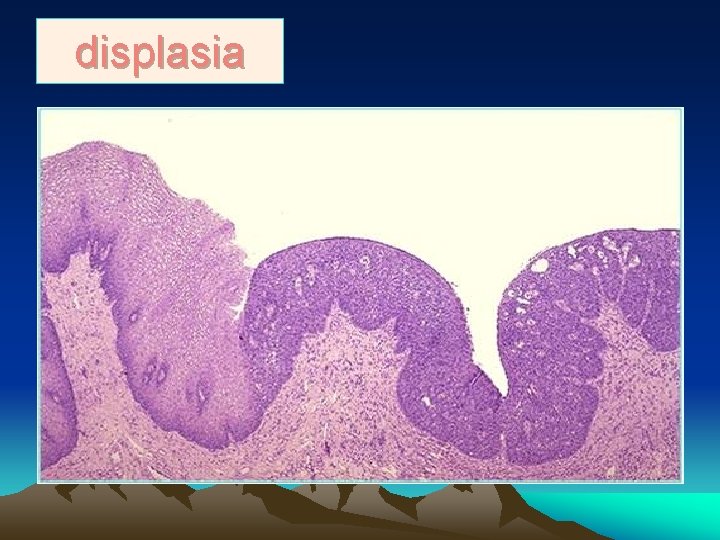 displasia 