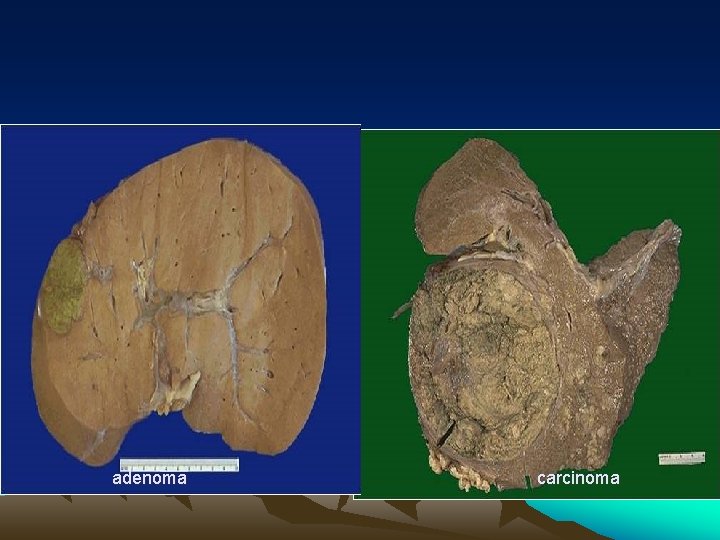 adenoma carcinoma 