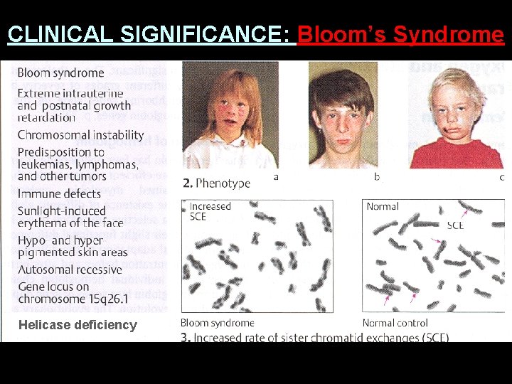 CLINICAL SIGNIFICANCE: Bloom’s Syndrome Helicase deficiency 