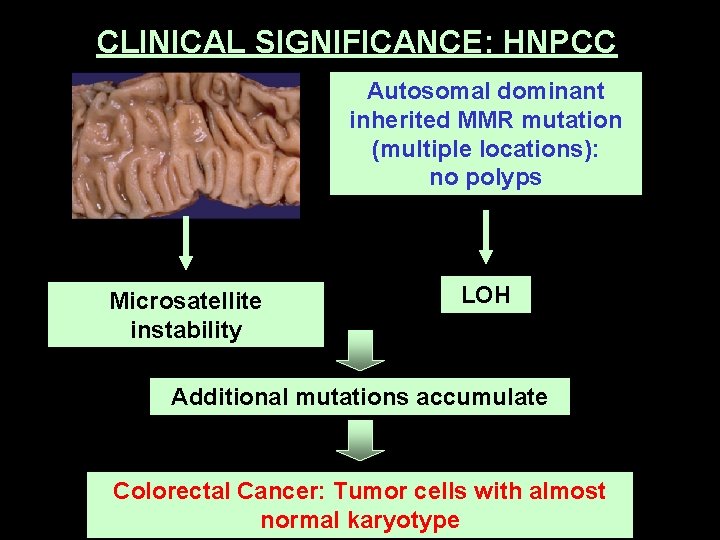 CLINICAL SIGNIFICANCE: HNPCC Autosomal dominant inherited MMR mutation (multiple locations): no polyps Microsatellite instability