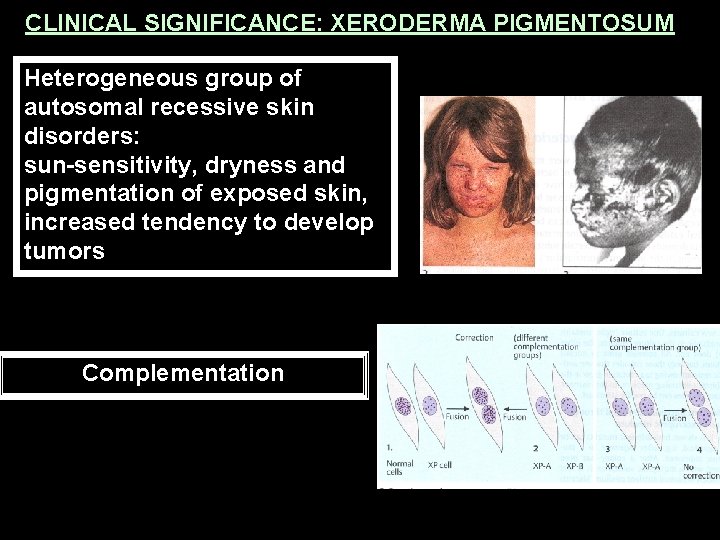 CLINICAL SIGNIFICANCE: XERODERMA PIGMENTOSUM Heterogeneous group of autosomal recessive skin disorders: sun-sensitivity, dryness and