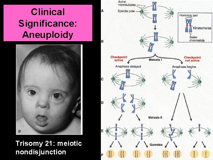 Clinical Significance: Aneuploidy Trisomy 21: meiotic nondisjunction 