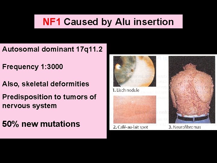 NF 1 Caused by Alu insertion Autosomal dominant 17 q 11. 2 Frequency 1: