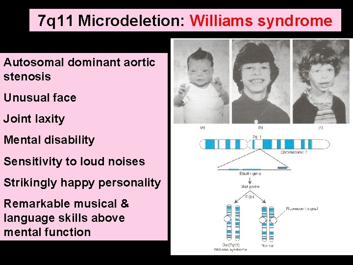 7 q 11 Microdeletion: Williams syndrome Autosomal dominant aortic stenosis Unusual face Joint laxity