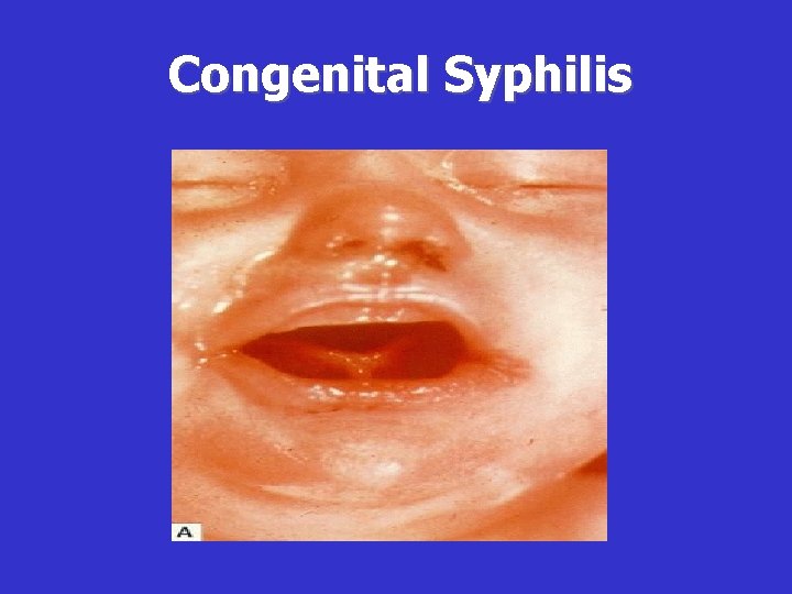 Congenital Syphilis 