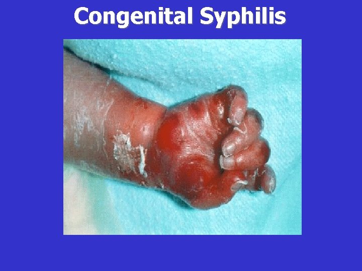 Congenital Syphilis 