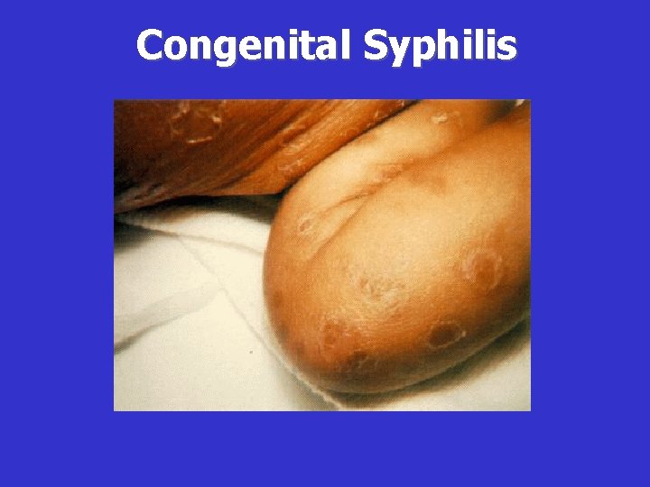 Congenital Syphilis 