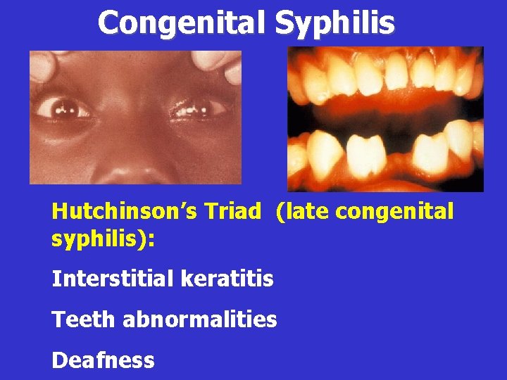 Congenital Syphilis Hutchinson’s Triad (late congenital syphilis): Interstitial keratitis Teeth abnormalities Deafness 