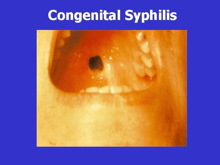 Congenital Syphilis 