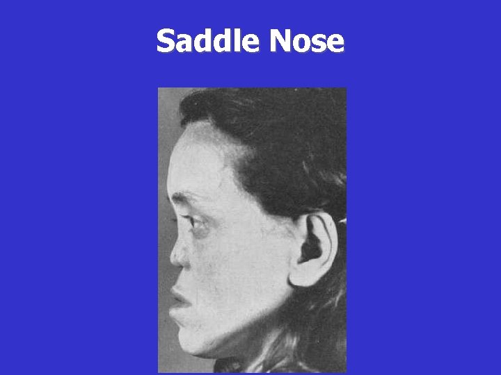 Saddle Nose 