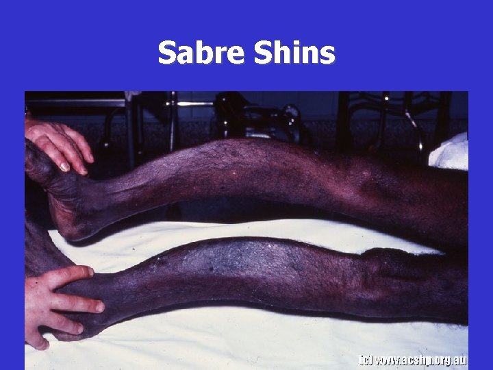 Sabre Shins 