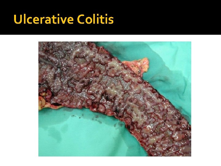 Ulcerative Colitis 