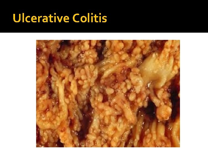 Ulcerative Colitis 