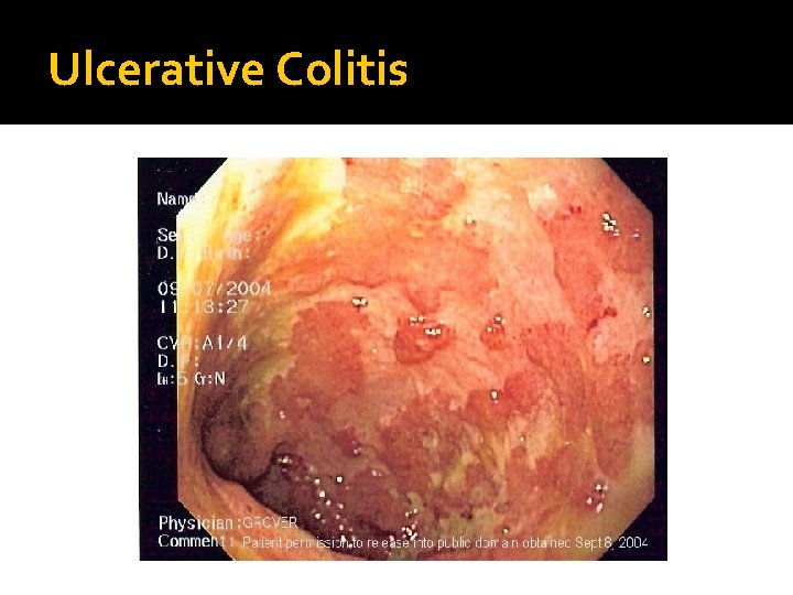 Ulcerative Colitis 