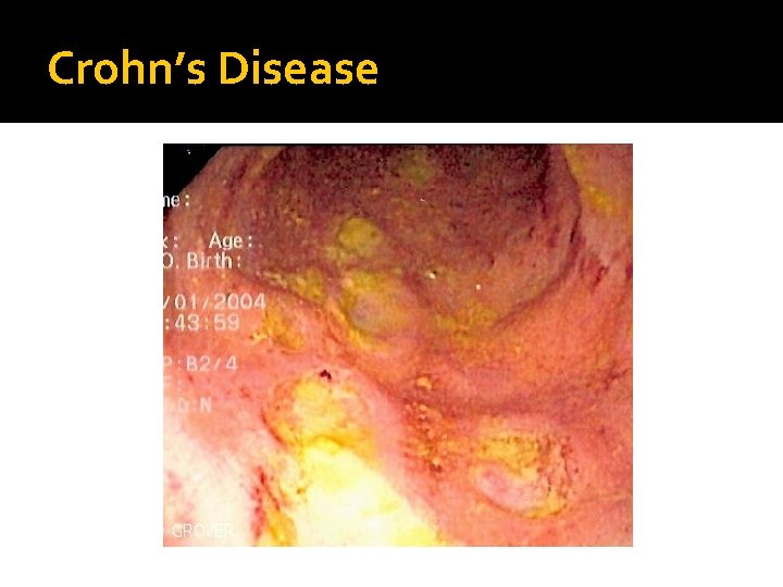 Crohn’s Disease 