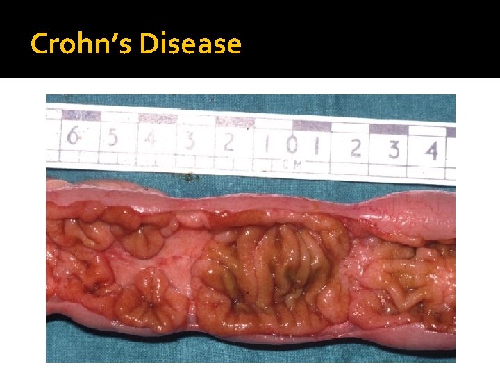 Crohn’s Disease 