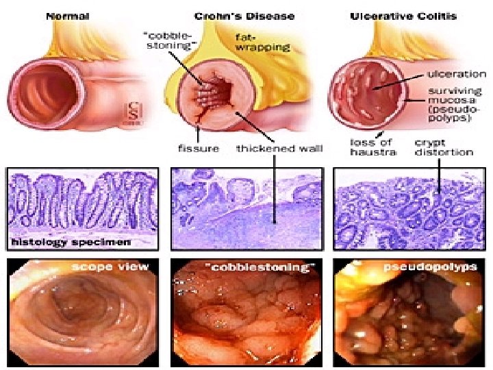 Inflammatory Bowel Disease 