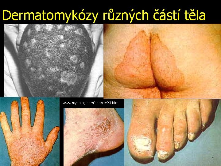 Dermatomykózy různých částí těla www. mycolog. com/chapter 23. htm 