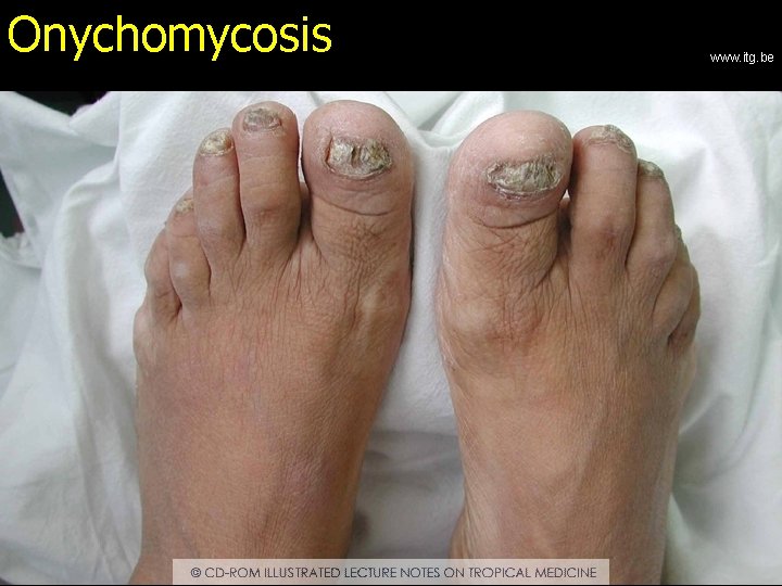 Onychomycosis www. itg. be 