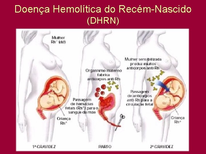 Doença Hemolítica do Recém-Nascido (DHRN) 