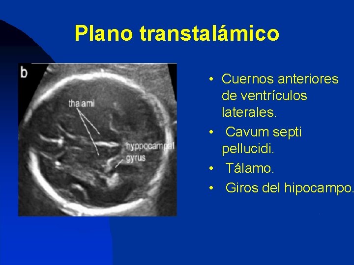 Plano transtalámico • Cuernos anteriores de ventrículos laterales. • Cavum septi pellucidi. • Tálamo.