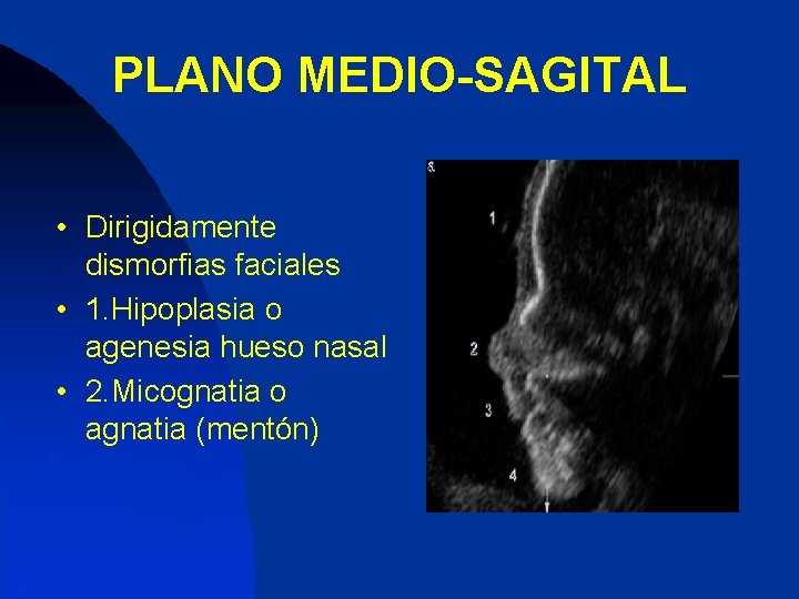 PLANO MEDIO-SAGITAL • Dirigidamente dismorfias faciales • 1. Hipoplasia o agenesia hueso nasal •