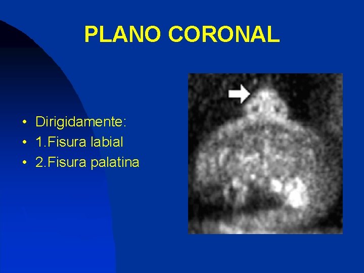 PLANO CORONAL • Dirigidamente: • 1. Fisura labial • 2. Fisura palatina 