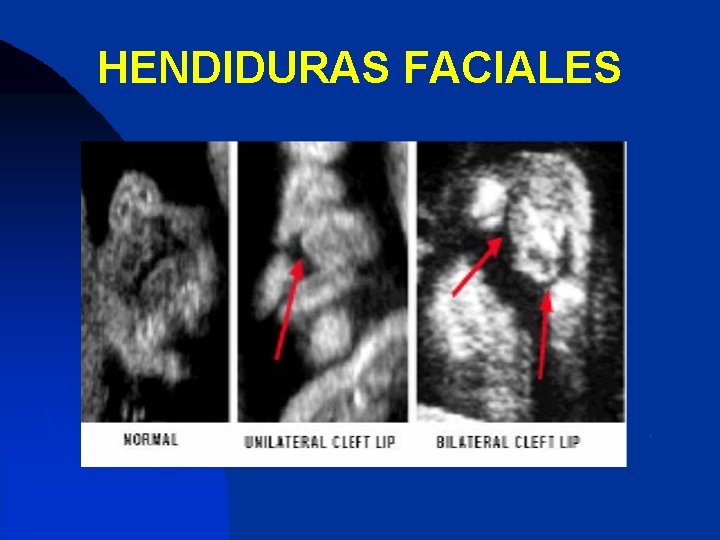 HENDIDURAS FACIALES 