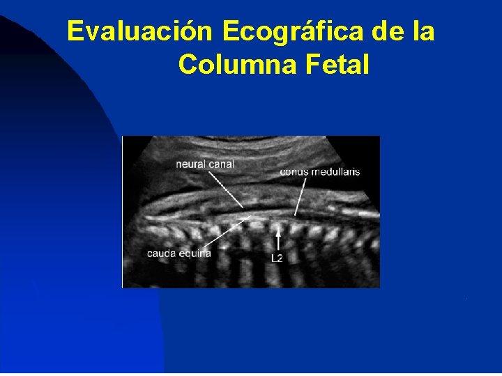 Evaluación Ecográfica de la Columna Fetal 