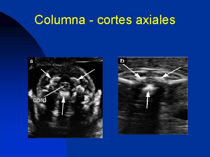 Columna - cortes axiales 