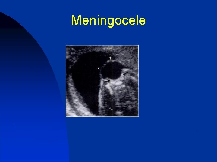 Meningocele 
