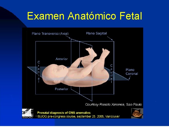 Examen Anatómico Fetal 