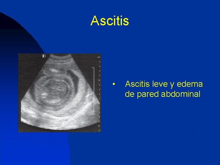 Ascitis • Ascitis leve y edema de pared abdominal 