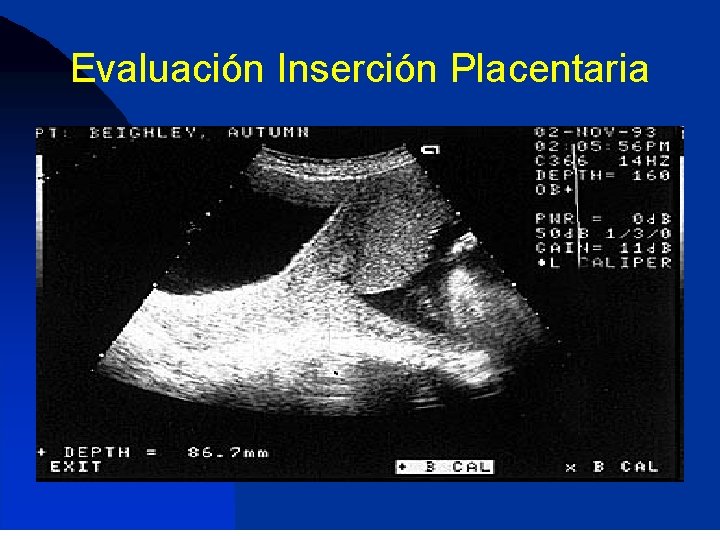 Evaluación Inserción Placentaria 