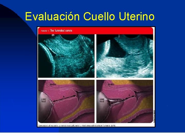 Evaluación Cuello Uterino 