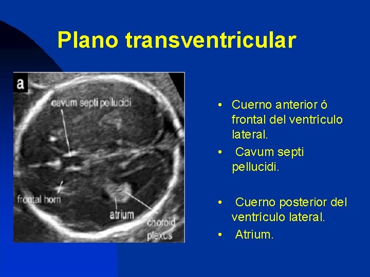 Plano transventricular • Cuerno anterior ó frontal del ventrículo lateral. • Cavum septi pellucidi.